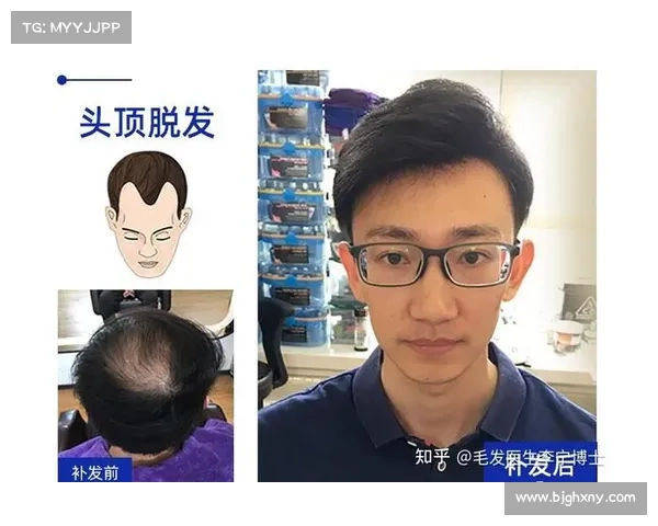 辐射脱发治疗:有效方法与注意事项 辐射脱发治疗:有效方法与注意事项